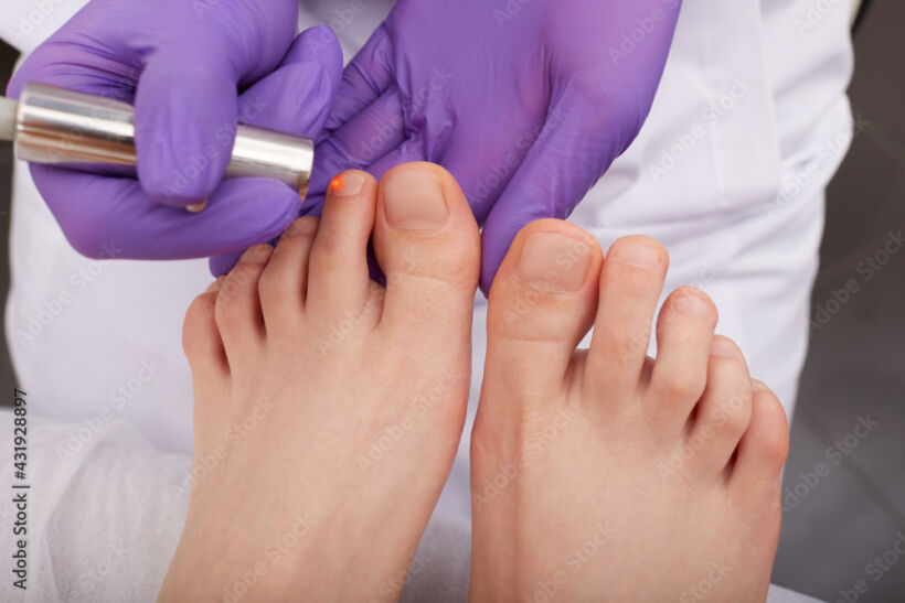 ingrown toenail prevention methods